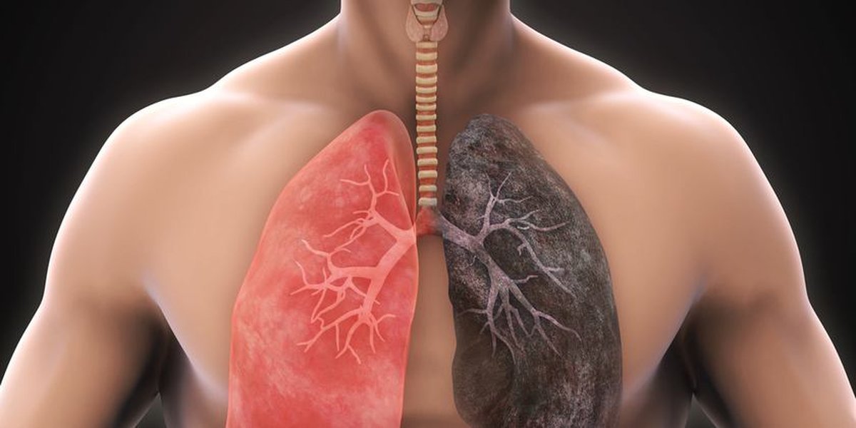 Es notable la interacci&oacute;n entre Asbesto y tabaco en el origen del carcinoma de pulm&oacute;n, por lo que fumadores pueden llegar a ser un sector m&aacute;s vulnerable. &nbsp;